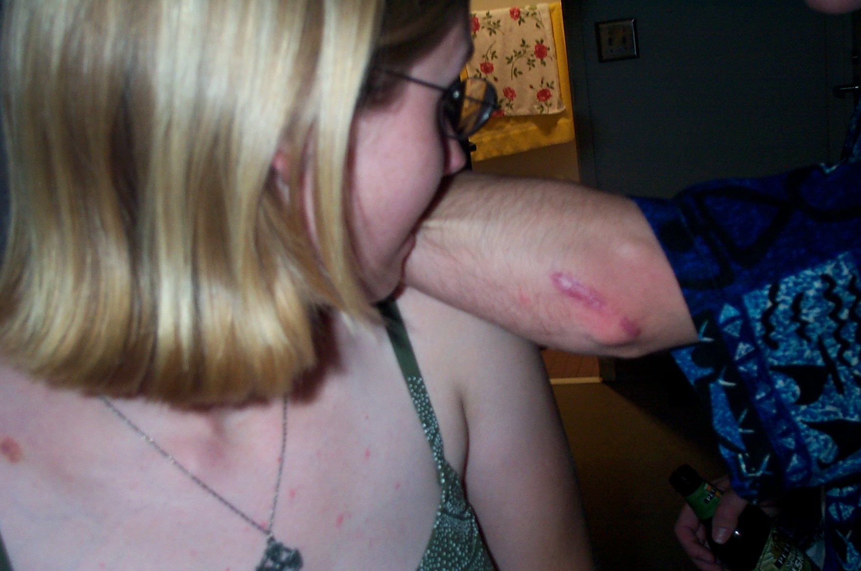 Amy and Alex's scar
