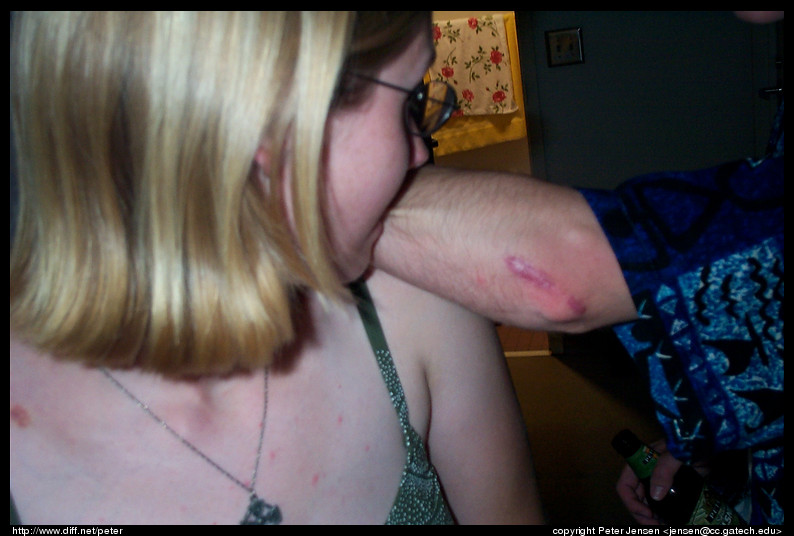 Amy and Alex's scar