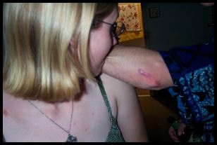 Amy and Alex's scar