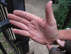 splinter from a 2x4; received through a glove