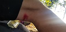 small cut - only real injury of the ride